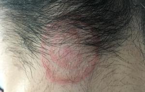 Brote de tiña en peluquerías españolas: ¿qué es, cuáles son sus síntomas y cómo se contagia?