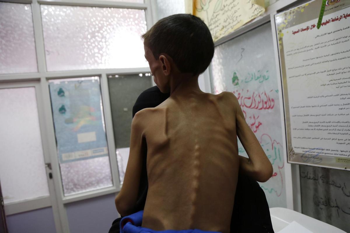 Imagen de archivo de un niño desnutrido en un hospital de Saná, en Yemen.