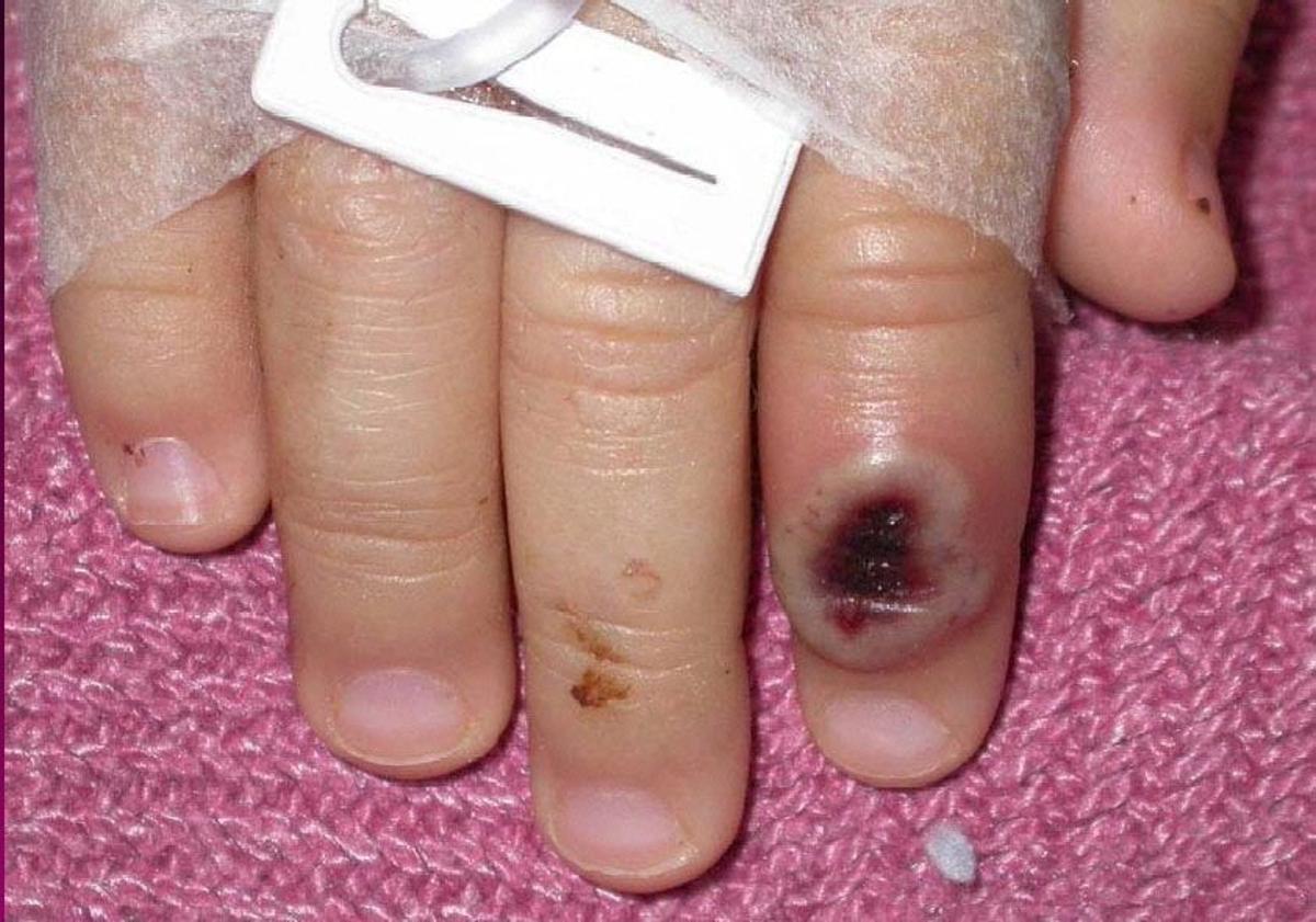 Fotografía de archivo del Centro Estadounidense de Control de las Enfermedades (CDC) en la que se aprecia el dedo de un niño infectado por la llamada viruela de mono (monkeypox).