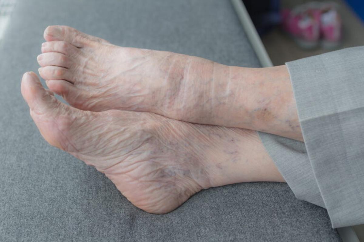 ¿Qué son y cómo se previenen las úlceras en las piernas, que afectan al 3% de los mayores de 60?