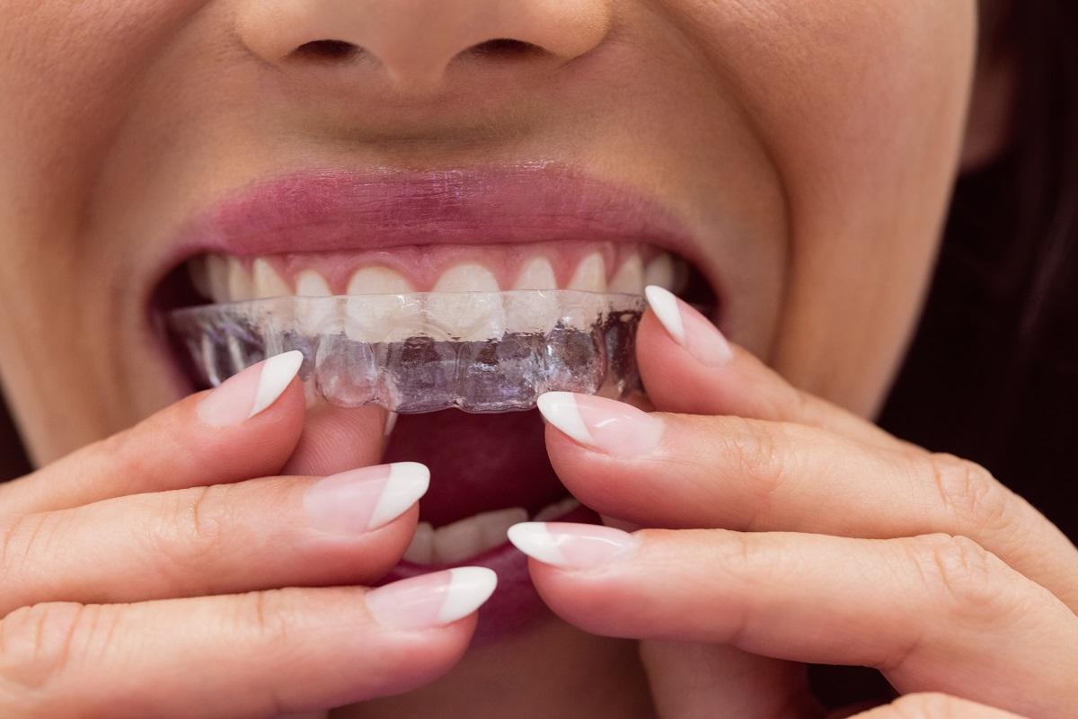 ¿Te rechinan los dientes? Es un problema que cada día afecta a más adultos ¿Te rechinan los dientes? Es un problema que cada día afecta a más adultos