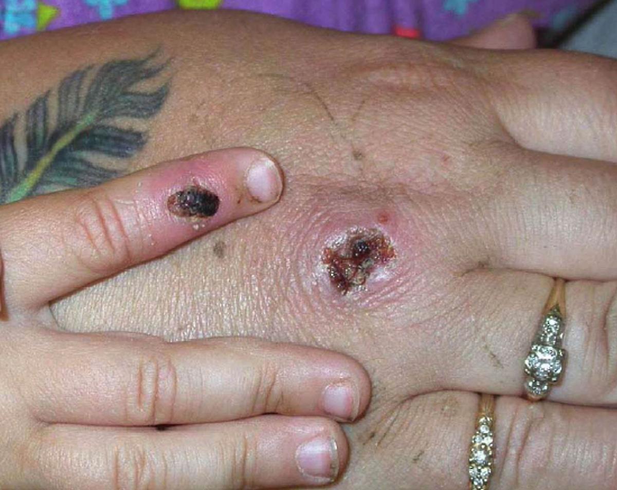 Un paciente con la enfermedad de la viruela del mono con una erupción cutánea en la mano.