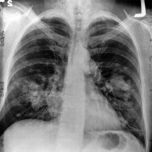 En España se diagnosticarán este año más de 30.000 nuevos casos de cáncer de pulmón. 