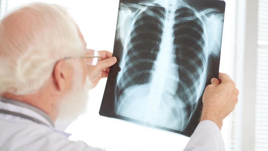 ¿Qué es un nódulo pulmonar y cómo se trata esta afección que no produce síntomas?